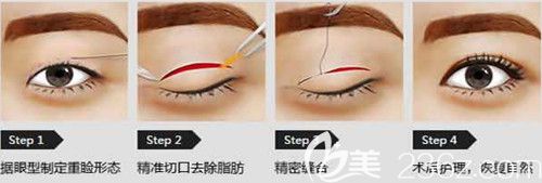 周瑞芳醫(yī)生做雙眼皮手術(shù)過程 周瑞芳醫(yī)生做雙眼皮手術(shù)過程