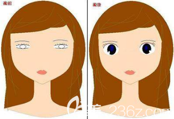 雙眼皮手術(shù)過(guò)程