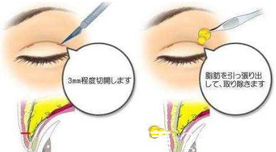 雙眼皮手術(shù)麻醉