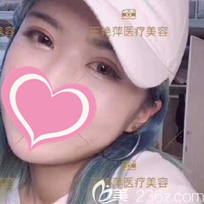 忍不住想分享腫泡眼的我做完全切雙眼皮手術(shù)40天后恢復(fù)自然的照片