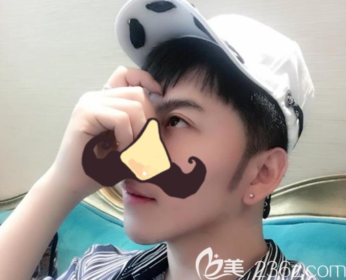 鬢角種植500毛囊7天后效果，跟發(fā)際線銜接自然“超原生態(tài)”