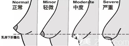 胸部不同的下垂程度 胸部不同的下垂程度