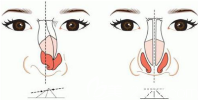 影響隆鼻價(jià)格的因素