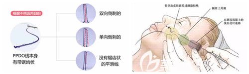 尹延喜醫(yī)生做埋線提升手術(shù)過程 尹延喜醫(yī)生做埋線提升手術(shù)過程