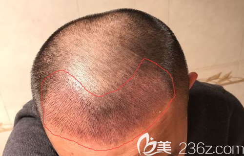 植發(fā)2600毛囊單位一周效果 植發(fā)2600毛囊單位一周效果