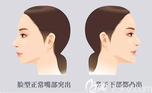 造成凸嘴的不同原因 造成凸嘴的不同原因