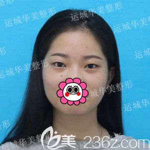 做開眼角前自己的內(nèi)眼角有些回包 做開眼角前自己的內(nèi)眼角有些回包