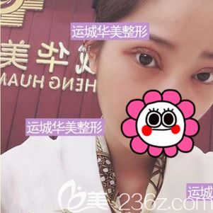 開眼角+微創(chuàng)雙眼皮術(shù)后即刻 開眼角+微創(chuàng)雙眼皮術(shù)后即刻
