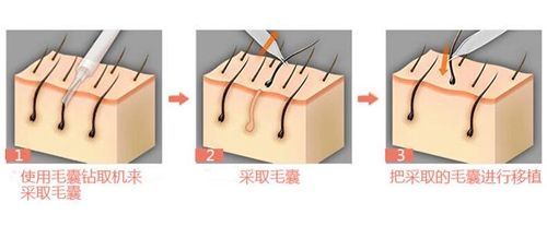 FUE種植技術(shù)的過(guò)程原理 FUE種植技術(shù)的過(guò)程原理