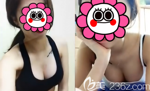 三次自體脂肪豐胸后站出來(lái)說(shuō)真相：一次填充從a到c只是噱頭