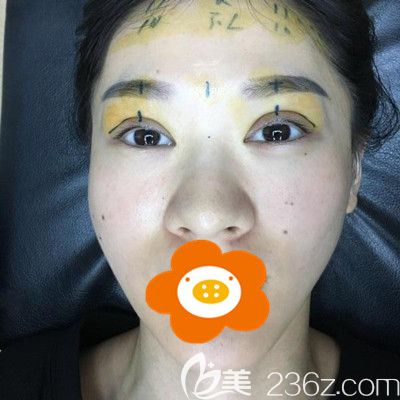 手術(shù)前躺在病床上醫(yī)生為我劃線