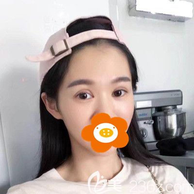 術(shù)后一周眼睛還是有點腫