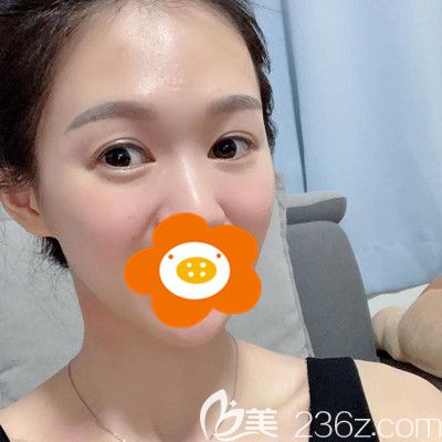 雙眼皮失敗修復(fù)已經(jīng)3個(gè)月了！一起來(lái)感受下被我喜歡的眼睛吧！