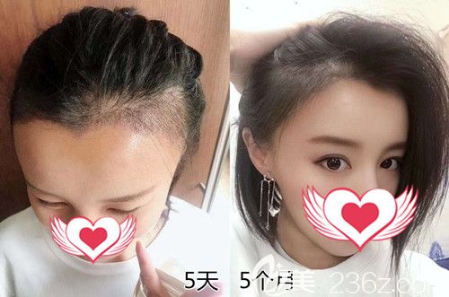 術(shù)后5天和5個月的效果對比 術(shù)后5天和5個月的效果對比
