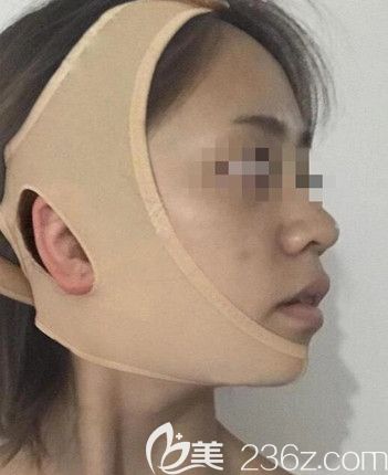 磨骨手術(shù)后要堅(jiān)持戴頭套