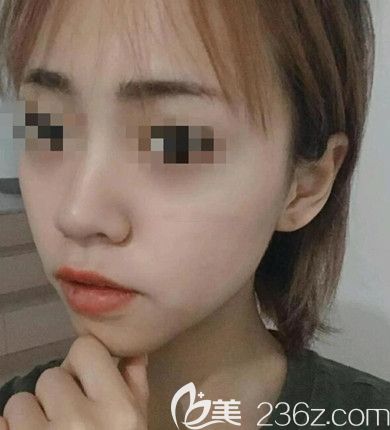 磨骨手術(shù)3個(gè)月恢復(fù)照片