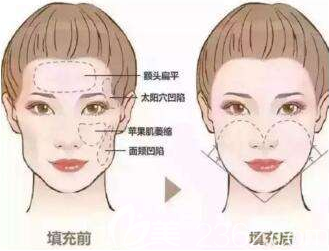 自體脂肪面部填充