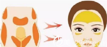 自體脂肪面部填充如何打造幼幼臉