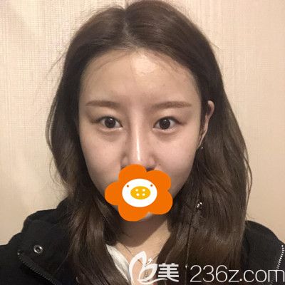 做雙眼皮手術(shù)前的照片 做雙眼皮手術(shù)前的照片