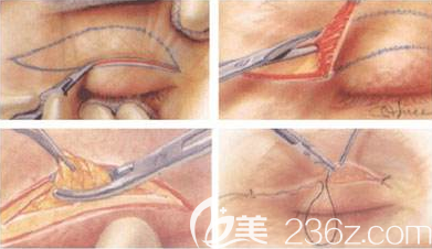 雙眼皮手術(shù)