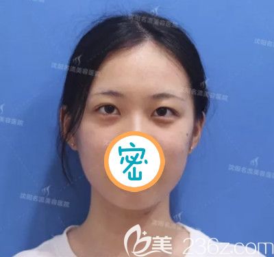 做雙眼皮開(kāi)眼角術(shù)前照 做雙眼皮開(kāi)眼角術(shù)前照