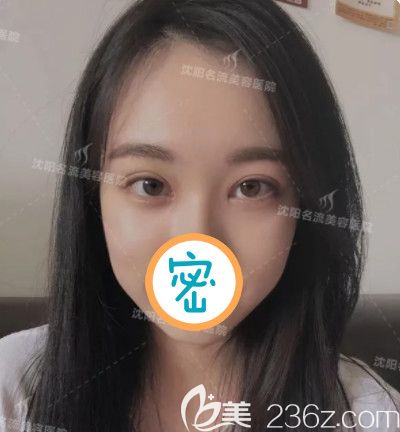 很慶幸當初選擇雙眼皮和開眼角一起做了，看恢復后水靈靈的大眼睛很撩人哦！