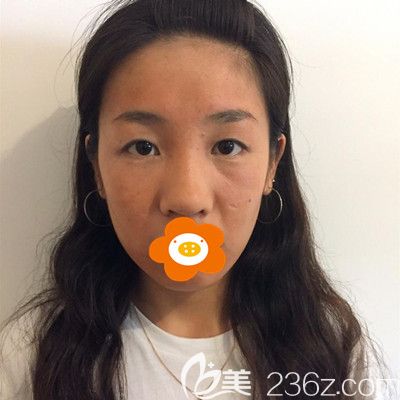 做雙眼皮隆鼻手術(shù)前的我 做雙眼皮隆鼻手術(shù)前的我