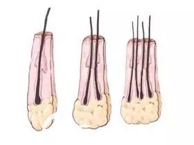 毛囊中的頭發(fā)數(shù)量在1-4根左右 毛囊中的頭發(fā)數(shù)量在1-4根左右