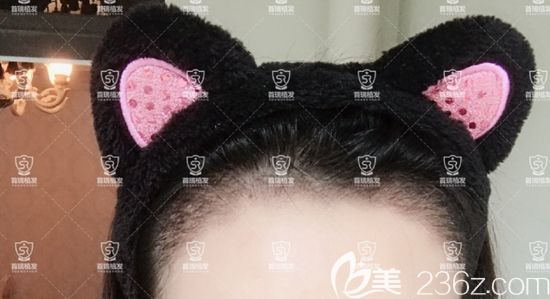 發(fā)際線線種植一周效果圖