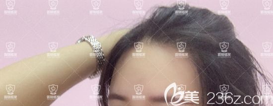 95后小姐姐來分享圓弧形發(fā)際線種植經歷，為了變美！所以“植”得