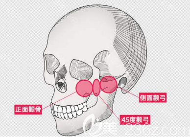 標(biāo)準(zhǔn)的顴骨