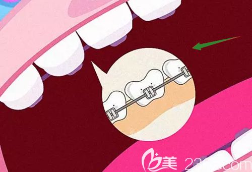 周瑾帆醫(yī)生解答什么是舌側(cè)矯正 周瑾帆醫(yī)生解答什么是舌側(cè)矯正