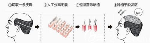 胡志浩醫(yī)生采用FUE植發(fā)技術(shù)