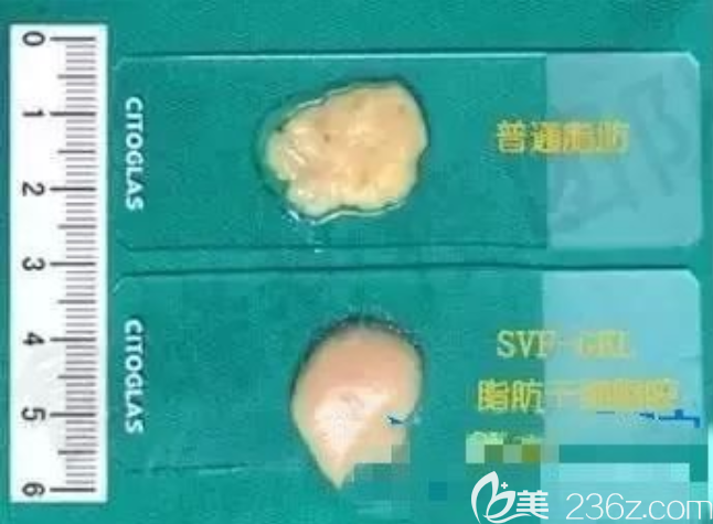 壞死和健康的脂肪細(xì)胞對比圖