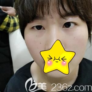 天生的大小眼真的非常難看 天生的大小眼真的非常難看