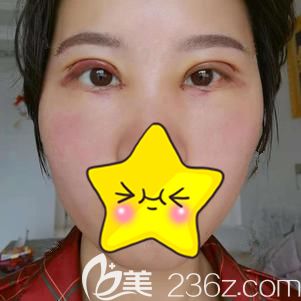 做完眼綜合手術后即刻腫脹明顯 做完眼綜合手術后即刻腫脹明顯