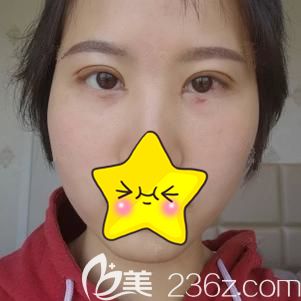 術后7天到院拆線輕微紅腫 術后7天到院拆線輕微紅腫