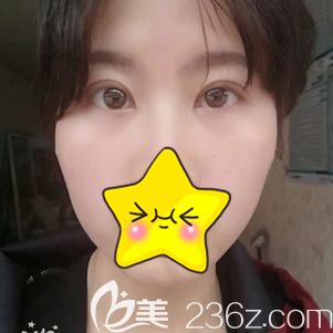 眼部整形術后25天腫脹已逐漸消除 眼部整形術后25天腫脹已逐漸消除