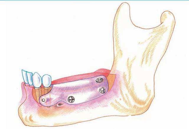 骨增量技術(shù) 骨增量技術(shù)