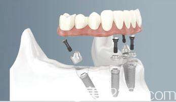 全口/半口種植牙 全口/半口種植牙