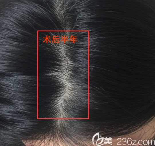 作為一個(gè)女性雄激素脫發(fā)患者,我選擇了頭頂加密種植挽回形象
