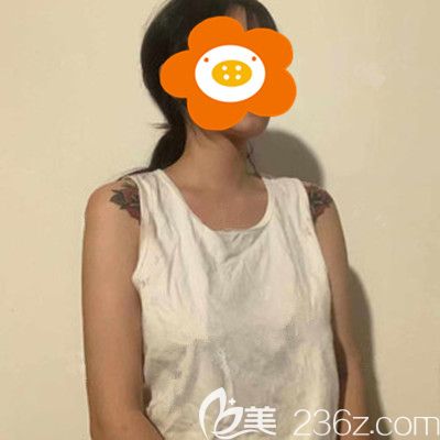 做隆胸手術前的照片 做隆胸手術前的照片