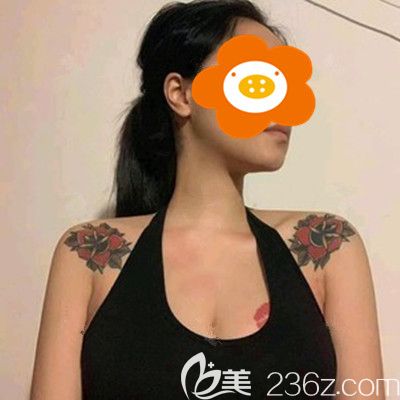 做完手術一個月效果 做完手術一個月效果