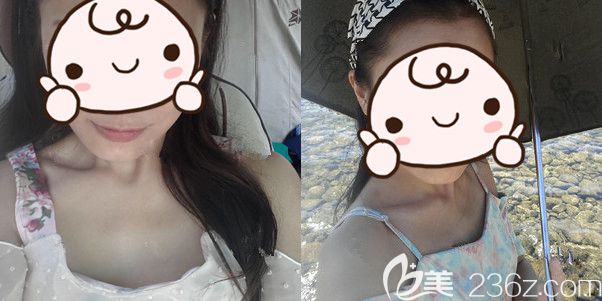 術(shù)前胸部較平罩杯較小 術(shù)前胸部較平罩杯較小