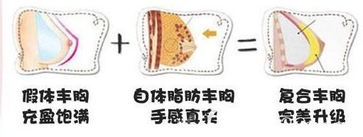 假體植入+脂肪填充的復(fù)合豐胸效果 假體植入+脂肪填充的復(fù)合豐胸效果