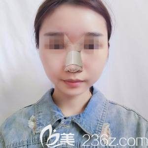 鼻綜合手術3天鼻子微腫脹