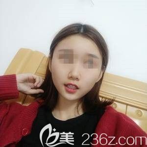 術后15天鼻子消腫不少