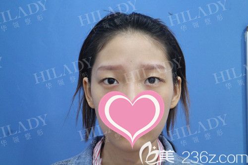 雙眼皮手術(shù)前照片 雙眼皮手術(shù)前照片