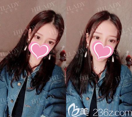 在線更新單眼皮的我割7mm全切雙眼皮手術(shù)過程以及恢復(fù)變漂亮的全部照片