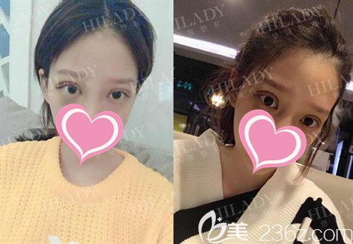 雙眼皮手術(shù)術(shù)后7天 雙眼皮手術(shù)術(shù)后7天